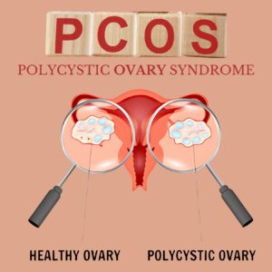 PCOS